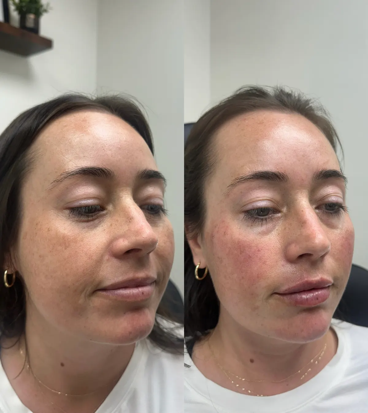 Full face balancing before and after at Glowtox, cheeks, under eyes and lips treated as one plan