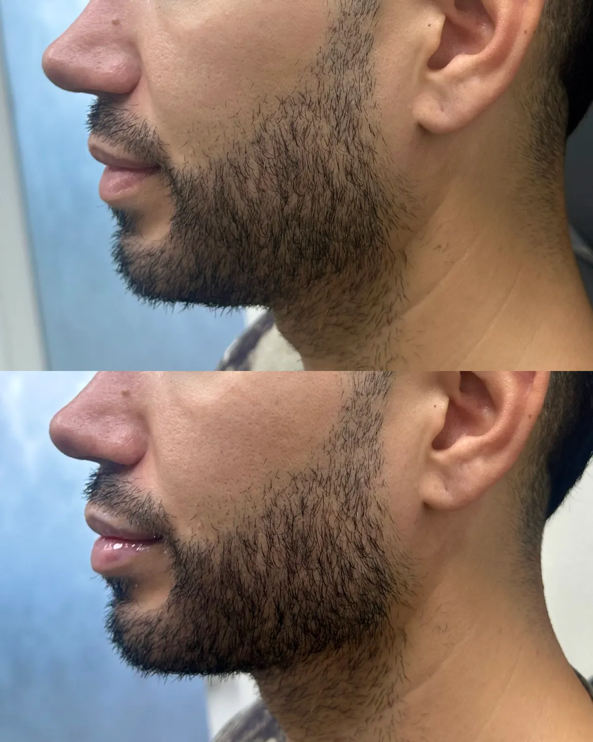 Male jawline filler before and after at Glowtox, sharper jawline definition