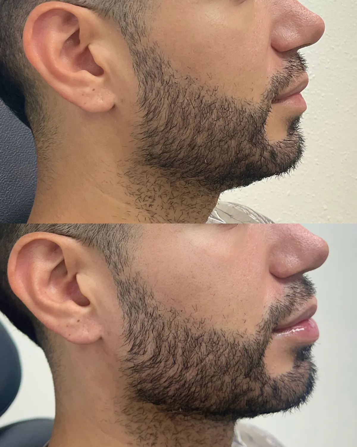 Male facial balancing before and after at Glowtox, stronger natural profile