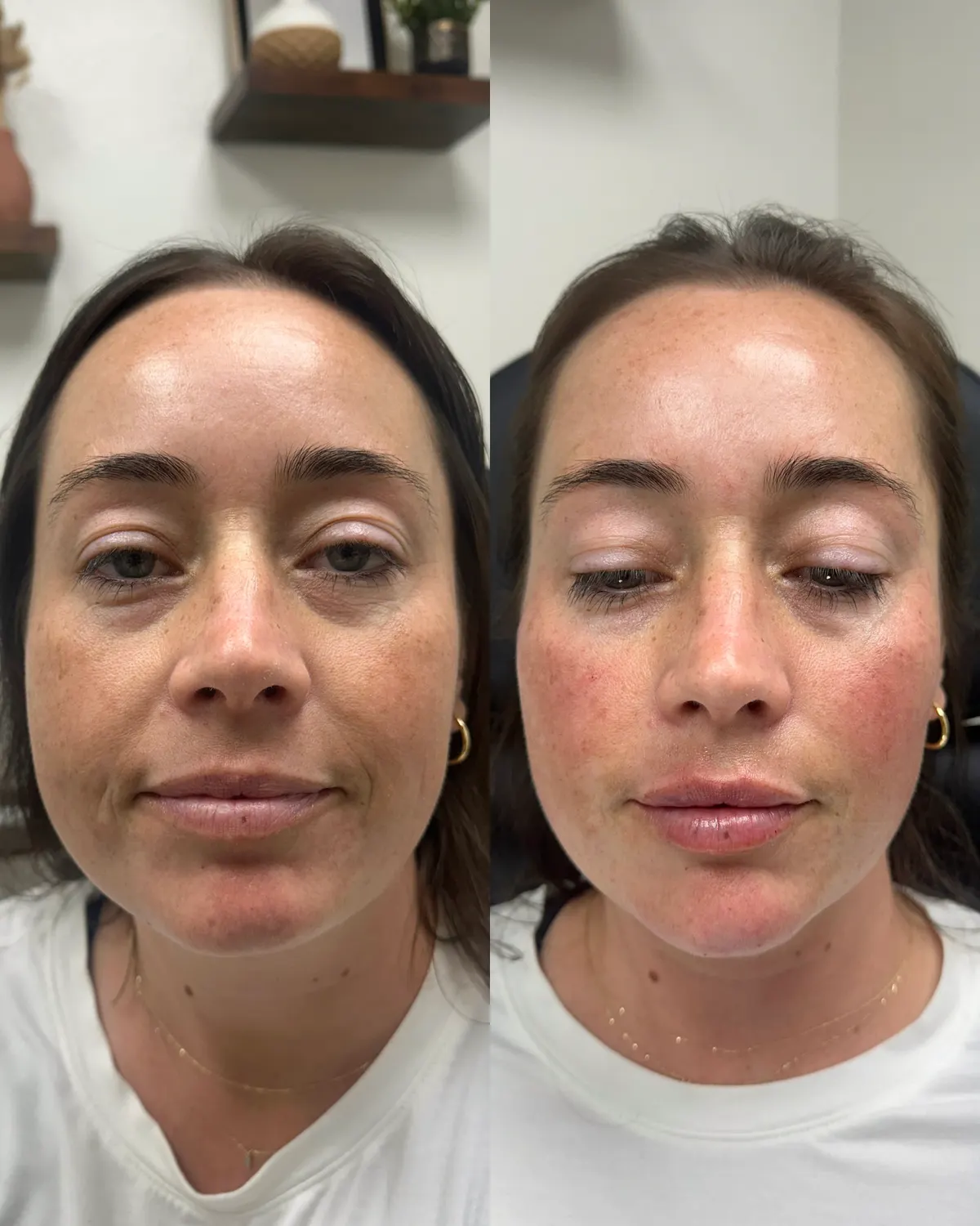Full face balancing before and after at Glowtox, softness restored across the midface