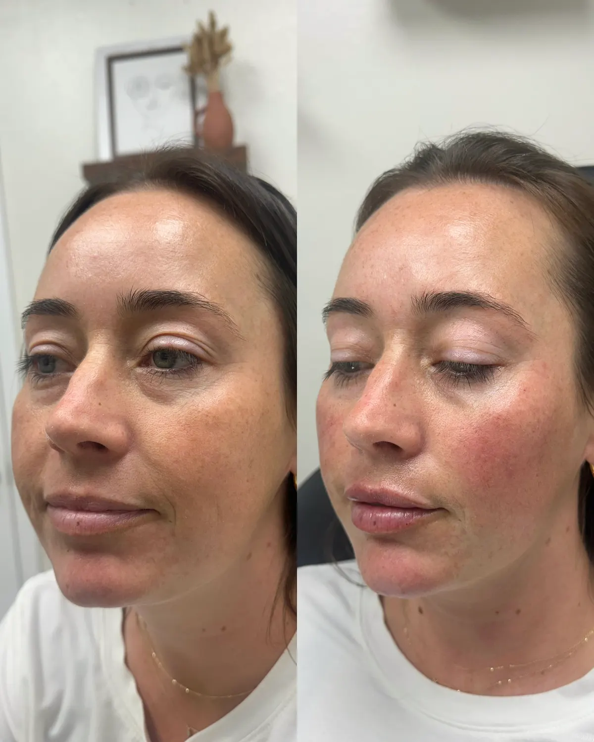 Facial balancing before and after at Glowtox, subtle volume in balanced proportions