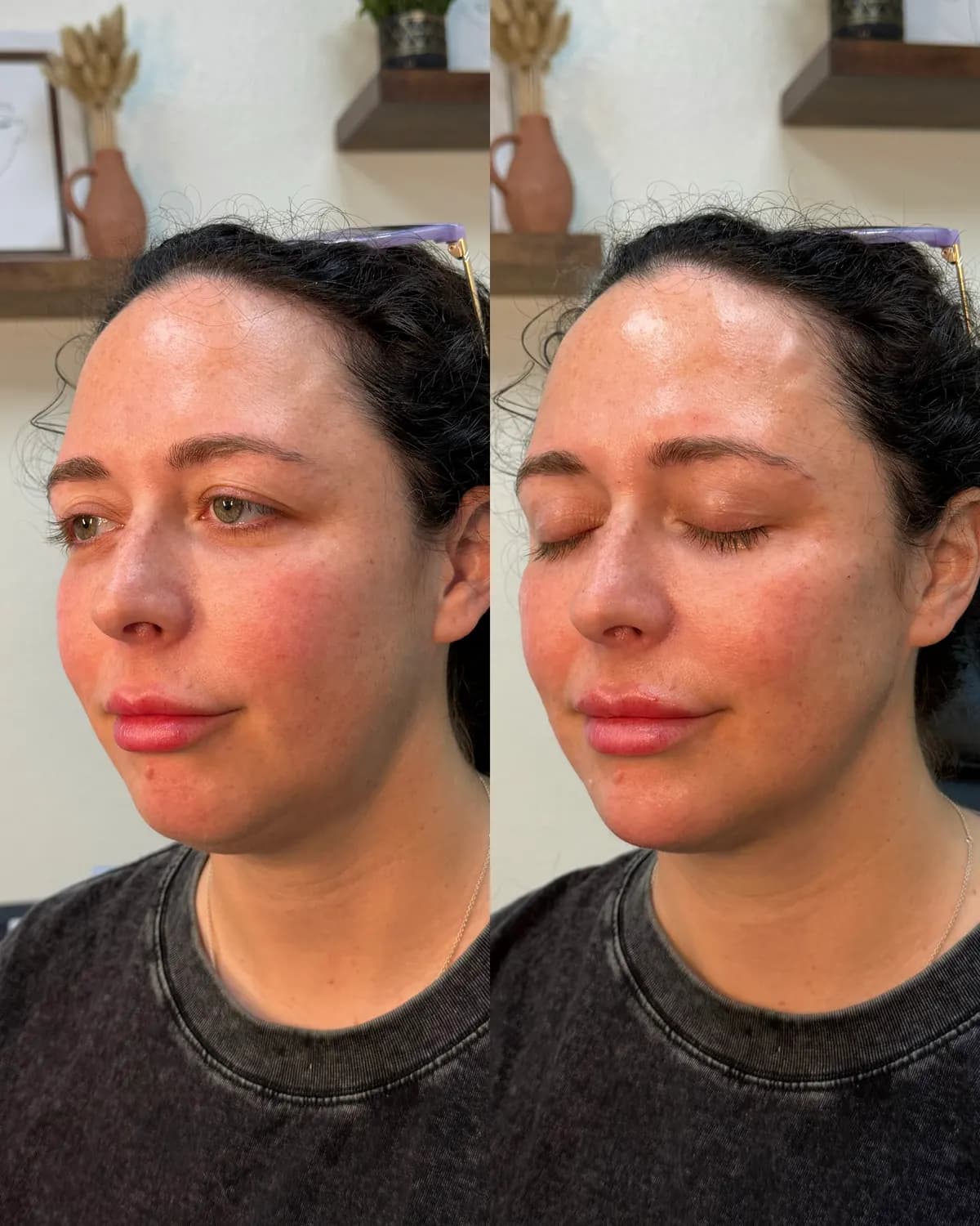 Facial balancing before and after at Glowtox, lips and chin brought into proportion
