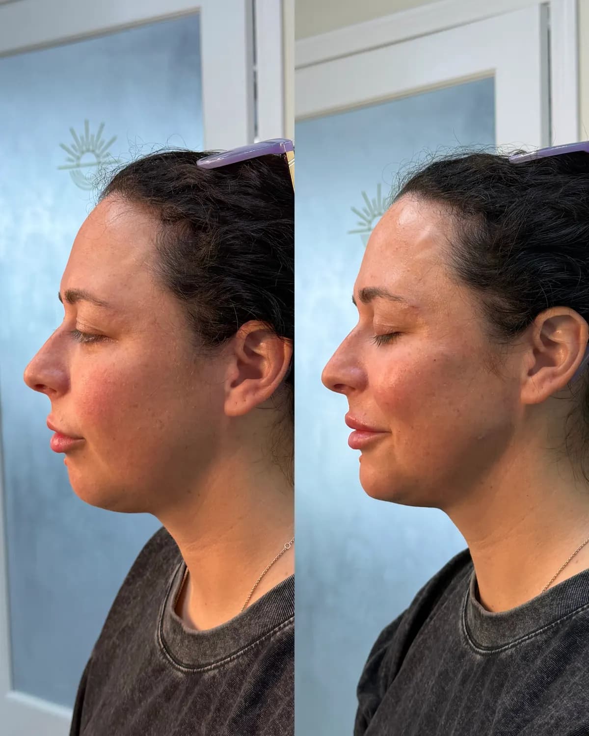 Facial balancing before and after at Glowtox, side profile with balanced chin and lips