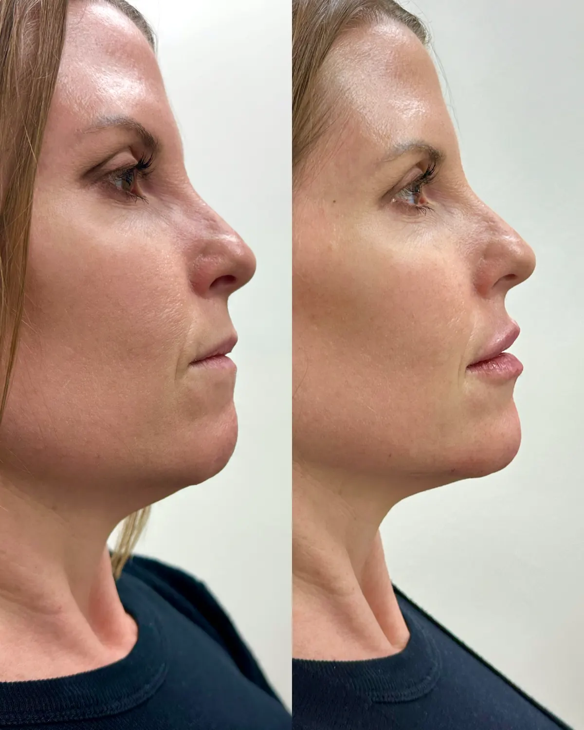 Facial balancing before and after at Glowtox, chin and jawline defined in side profile