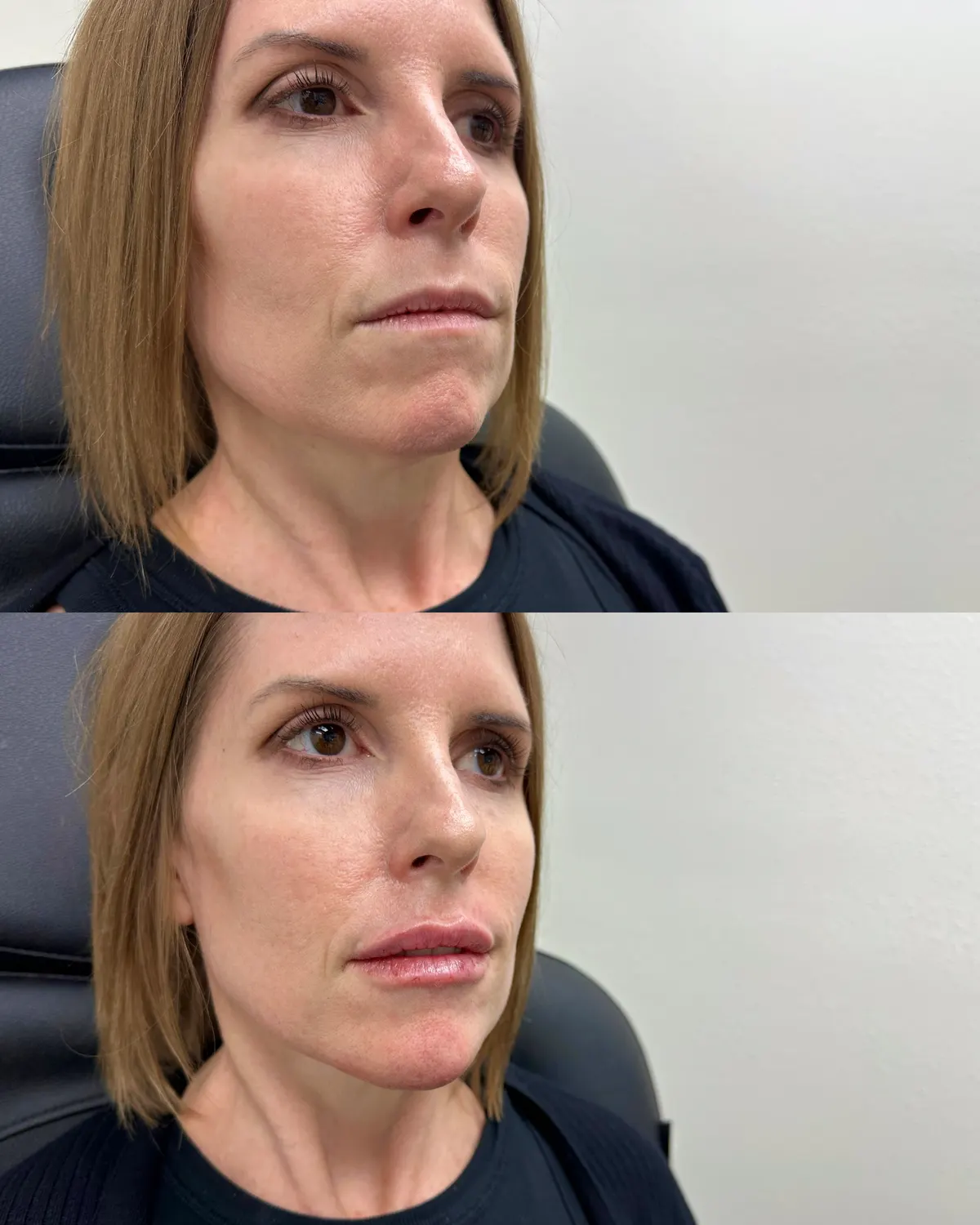 Facial balancing before and after at Glowtox, jawline, chin and lips in harmony