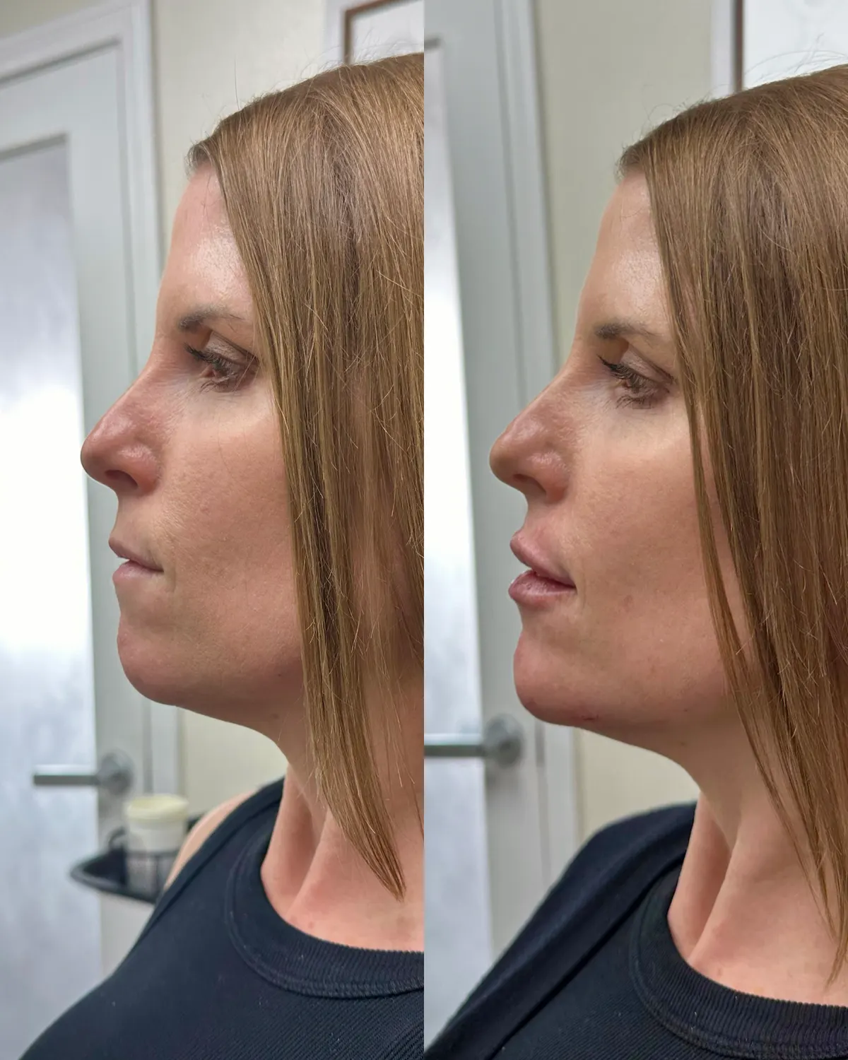 Facial balancing before and after at Glowtox, balanced side profile