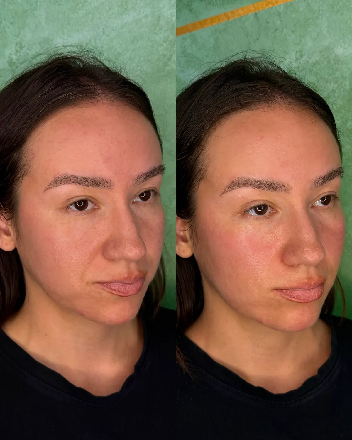 Facial balancing before and after at Glowtox, refreshed and rested look